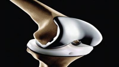 Government reduces the Knee Implant rates