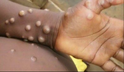 Study finds Monkeypox does not transmit easily by air
