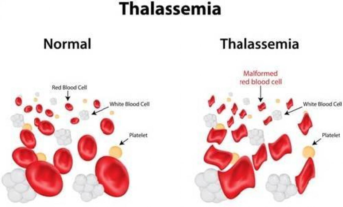 'Saviour Sibilings' in India with 10/10 HLA to donate Bone Marrow