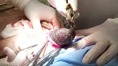 Doctors remove two kilo hair ball from UP girl's stomach