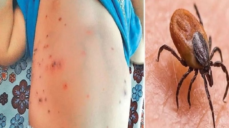 Odisha, Shimla Confirm 14 Deaths Caused by Scrub Typhus; Know All  About the Virus