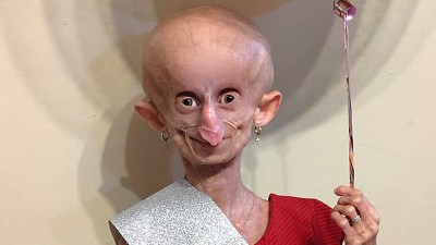 Who was Beandri Booysen? The inspiring Tik Tok star and icon who died suffering from rare condition ‘Progeria’