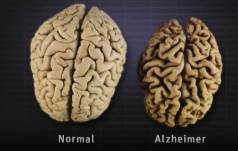 United States approves new Alzheimer's drug