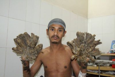 The Bangladeshi nationalAbul Bajandar, suffering from illness 'Tree Man', back to home after surgeries