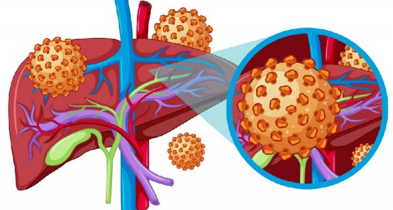 World Hepatitis Day: WHO Calls Southeast Asia to Strengthen Efforts Against Hepatitis B and C