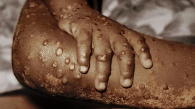 Over 80 cases of monkeypox confirmed in 12 countries: WHO