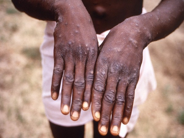 Monkeypox menance likely undercounted: Dr.Fauci