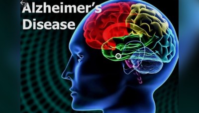 ऑस्ट्रेलियाई शोधकर्ता ने की अल्जाइमर रोग के संभावित कारण की पहचान