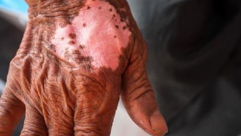 Which Country is the First to Eliminate Leprosy?