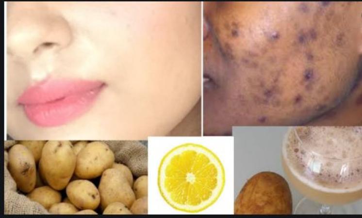 Potato face pack helps to remove acne scars and pimple spot reduction by use in this way…