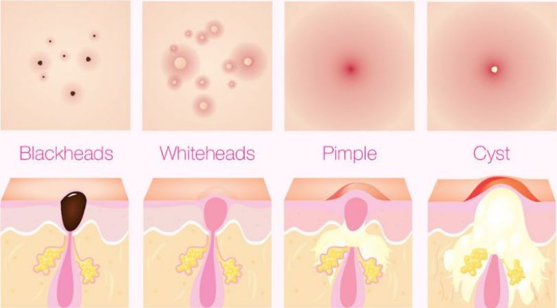 Difference between a Pimple, Whitehead, Blackhead and a cyst