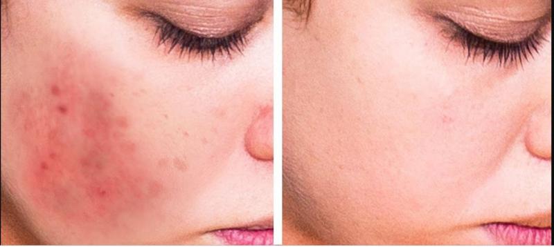 Use these kitchen products and reduce acne scars and get a clearer skin