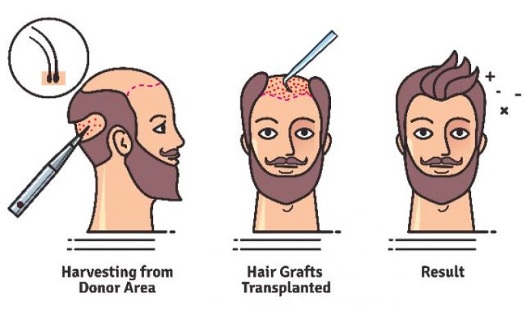 Know everything about hair transplant