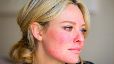 5 Easy remedies to reduce Rosacea or Skin Redness