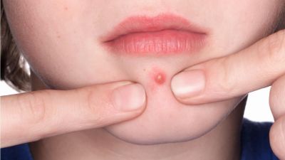 4 Home remedies to get rid of chin pimple