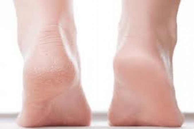 If cracked heels are becoming a cause of embarrassment and discomfort, then these home remedies will be of great help