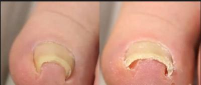 Give proper attention to your feet with these dos and don’t for your ingrown toenail issue