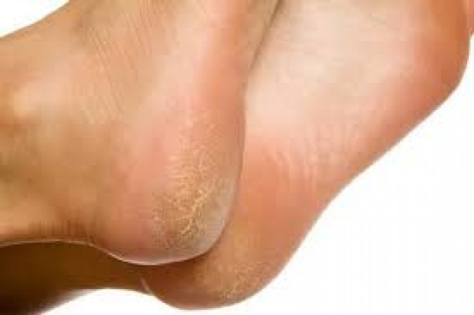 If hands and feet become dry after waxing then use these things, you will get relief from dryness
