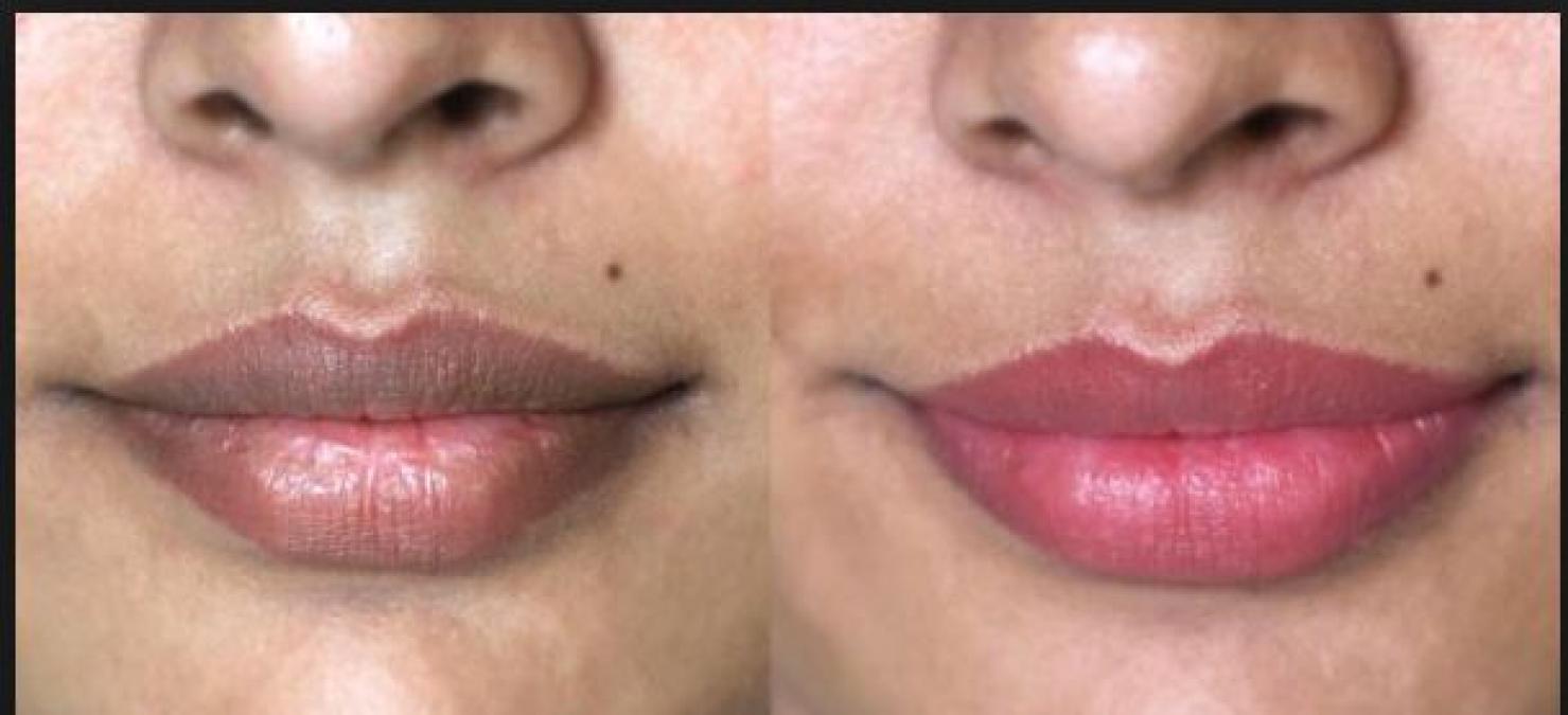 Darken Lips can be lightening up by applying these natural ingredients…