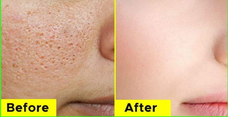 Best Home Remedies to get rid of large pores and blemishes