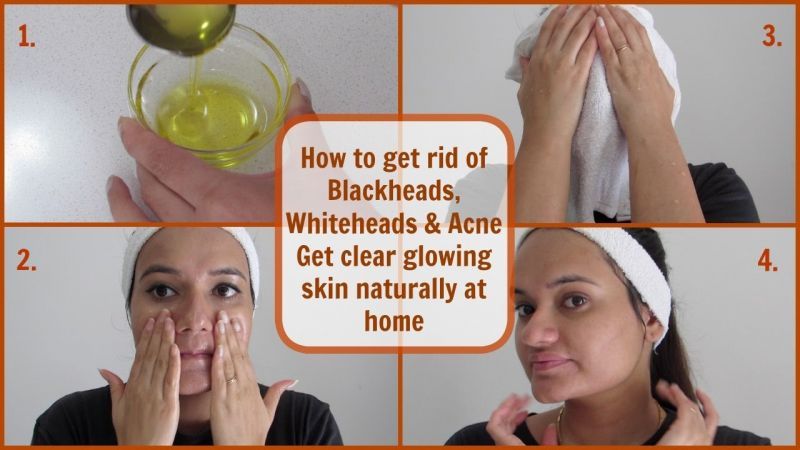 With this method, get rid of White Heads from the face