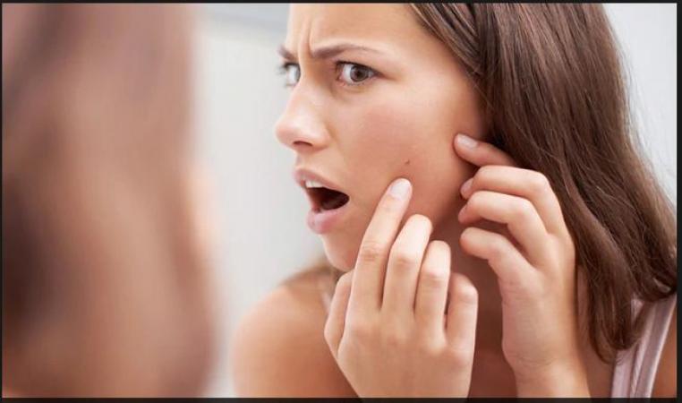Dermatologist recommending Acne and pimples home care  remedies