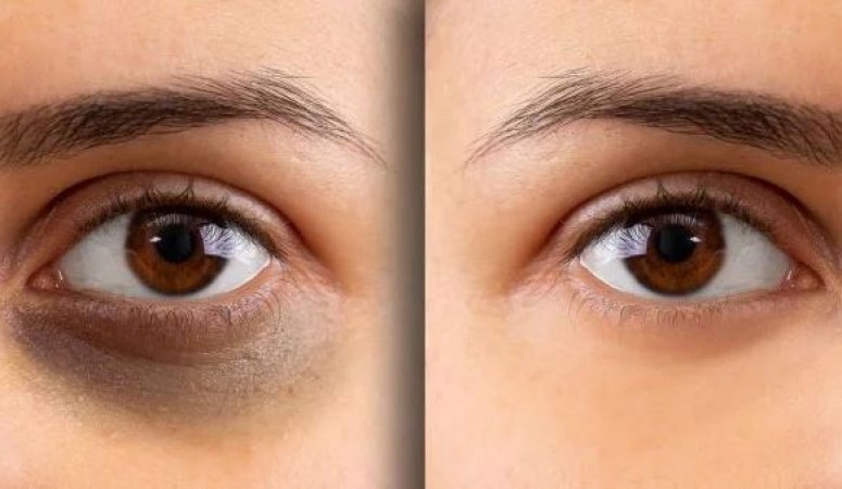 How to Remove Dark Circles at Home