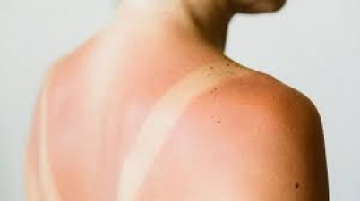 These 4 things in the kitchen will save you from sunburn, know from the expert