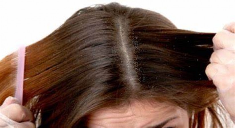 How to Manage and Control Dandruff: Effective Tips and Home Remedies