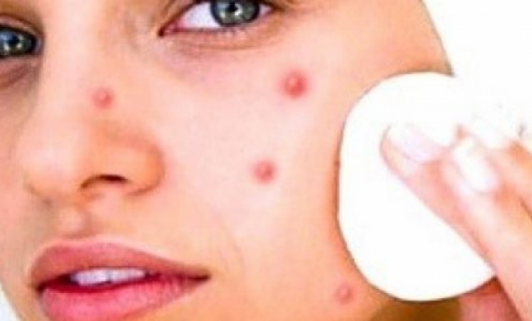 Curing pimples and blemishes ASAP
