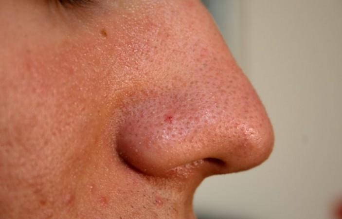 Check Out These 7 Home Remedies To Get Rid Of Blackheads