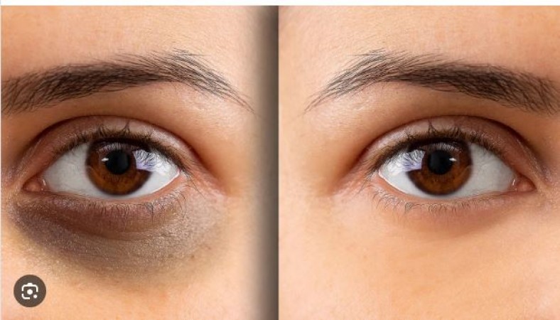 Say Goodbye to Tired Eyes: Effective Methods for Eliminating Dark Circles