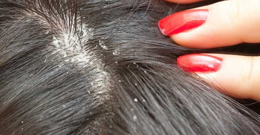 These Essential Tips Will Help You Prevent Dandruff in Monsoon, Start Now