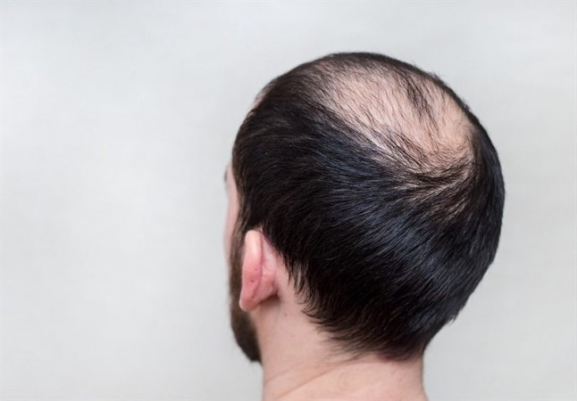 How can you tell if your hair loss is typical or unusual?
