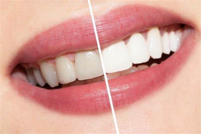 घर पर प्राकृतिक रूप से दांतों को सफेद कैसे करें