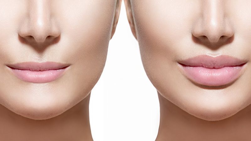 Get pout lips without surgery