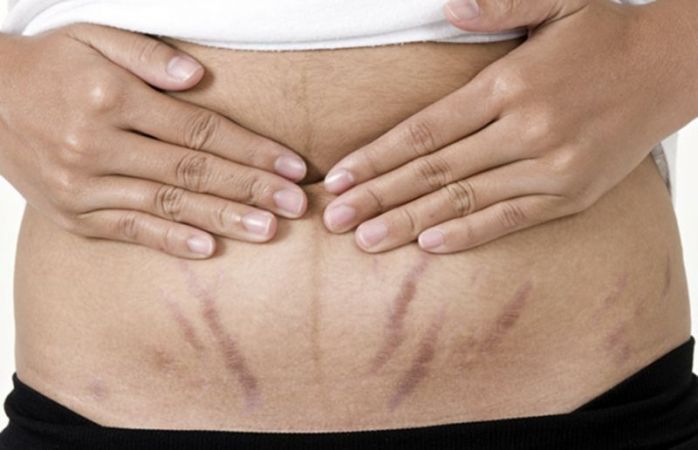 Having STRETCH MARKS -  Use these methods