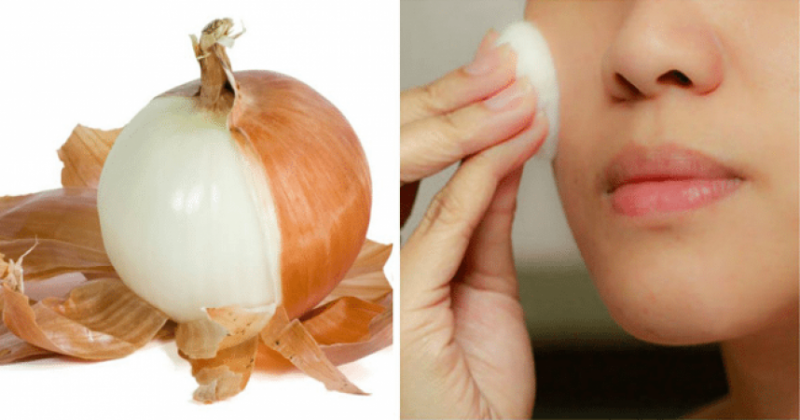 Beauty benefits of onion peels