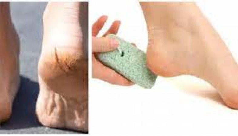 These tips will be useful to get relief from cracked heels in winter