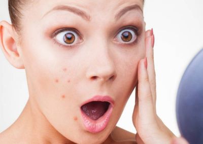 These natural ways will relieve  you from the problem of pimples