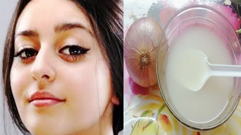 Facial scars wll remove with Onion juice