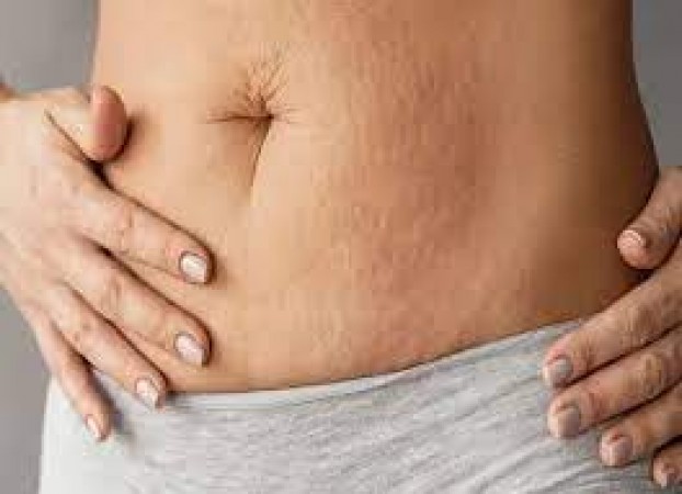 If you are troubled by stretch marks then these home remedies will be helpful