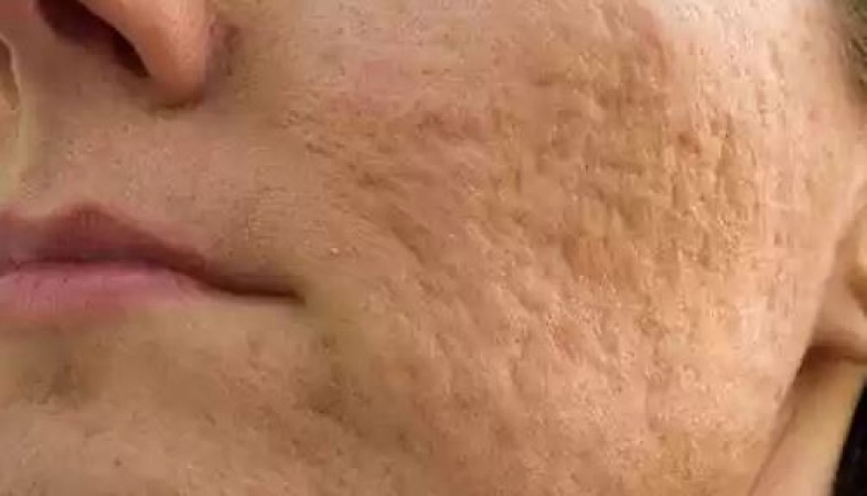 Why do pits form on the face after acne, what is its treatment?