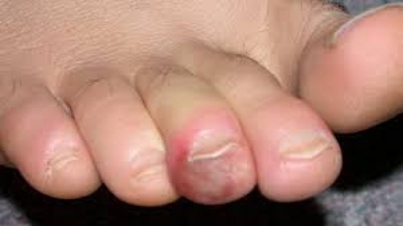 If the fingers and toes have become red due to swelling in winter, then use these things, you will get relief