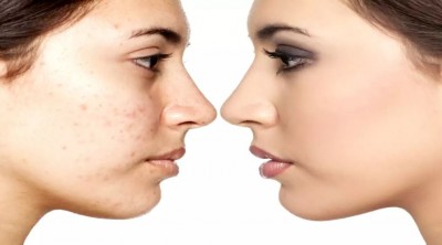 How to Remove Spots and Blemishes on Your Face with These Tricks