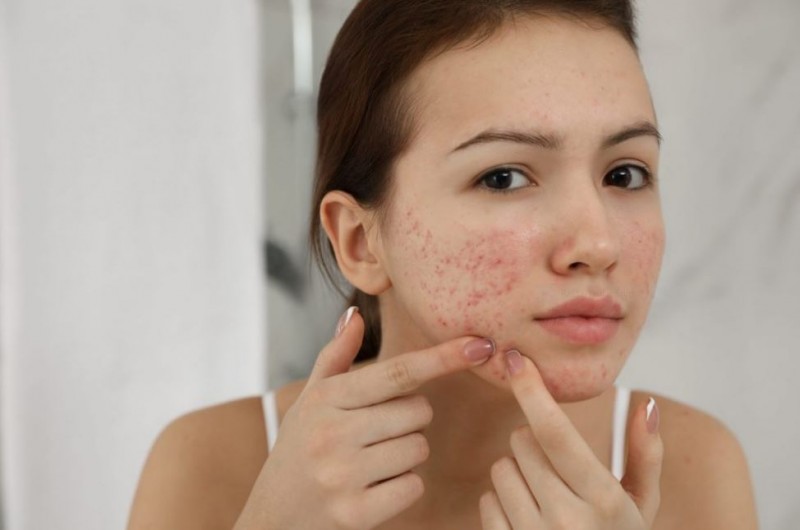 Effective Home Remedies for Acne-Free Skin