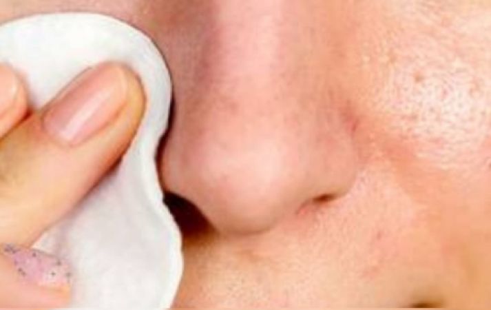 Home remedies to treat your Blackheads
