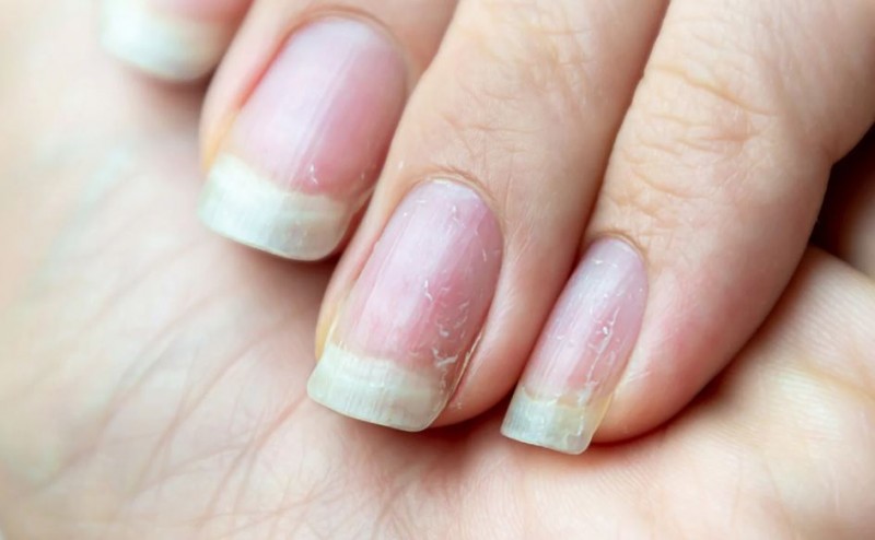 Best Treatments for Brittle Nails: Restoring Health and Strength