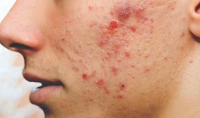 How These Food Items Can Cause Pimples