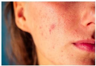 How to prevent acne in summer?